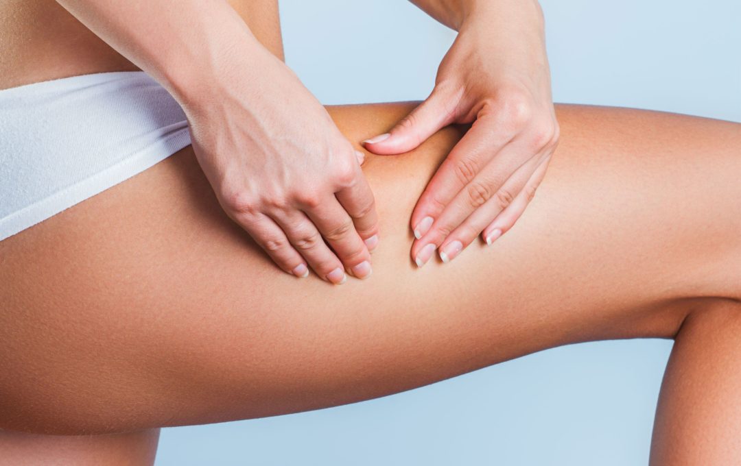 Cellulite Treatment: Does It Work?